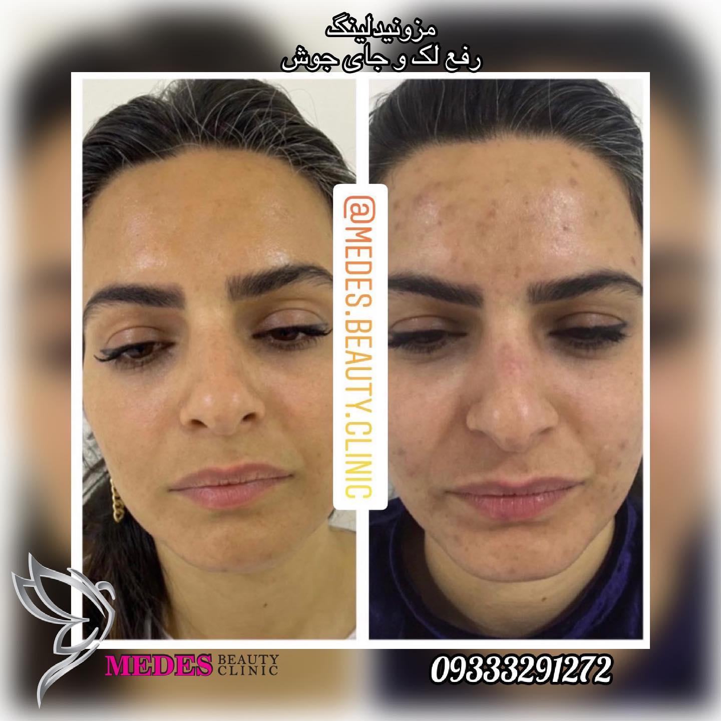 گالری مزونیدلینگ